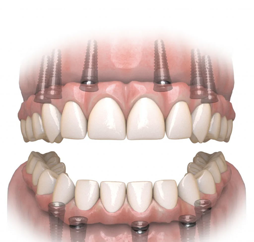 All-on-X : Une solution fixe pour remplacer toutes les dents d’une mâchoire