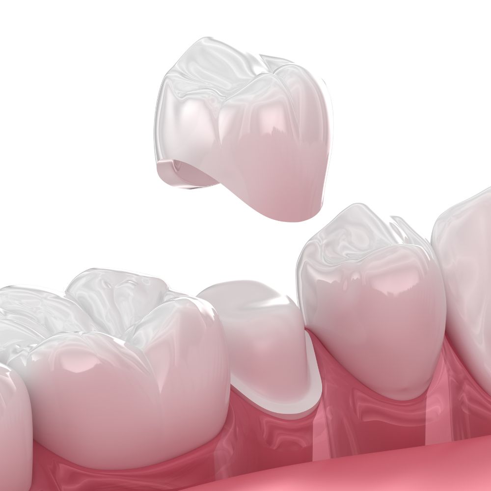 Les risques d’une couronne descellée