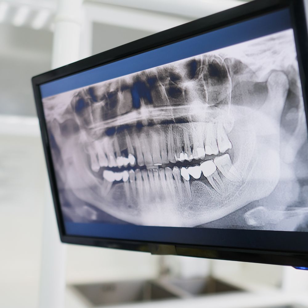 Radiographies dentaires : sont-elles dangereuses ?